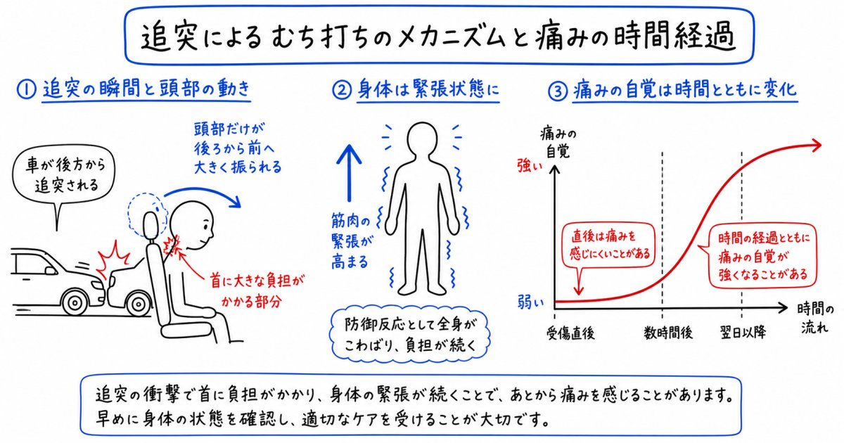 追突事故直後に痛くない医学的メカニズムとよくある誤解